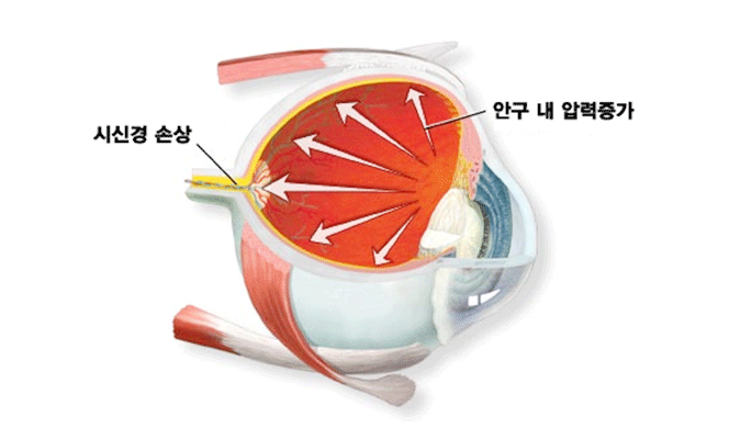 메트로성모안과 녹내장